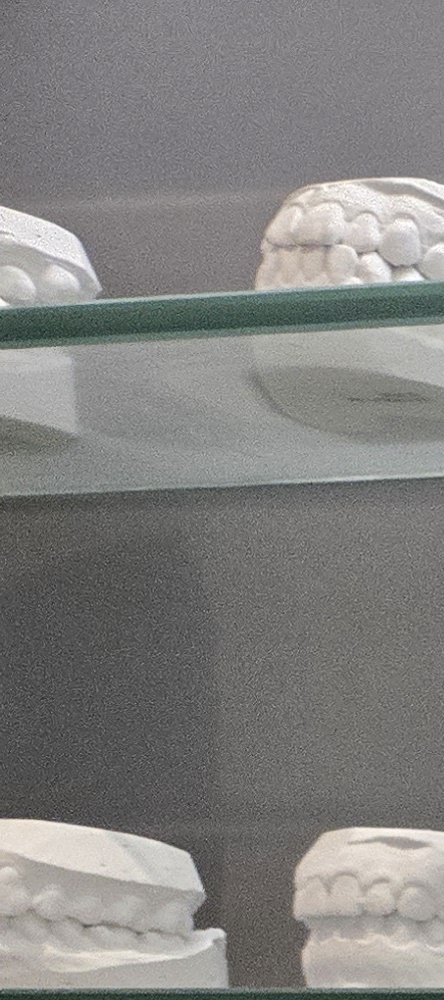 앞이빨 임플란트 과정 주의해야할 포인트는 관련 이미지 9