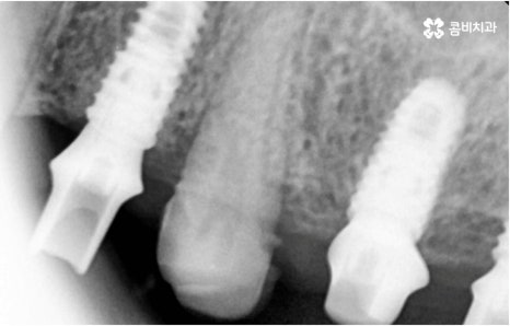 명동치과 타고난 이의 수명은 관련 이미지 13