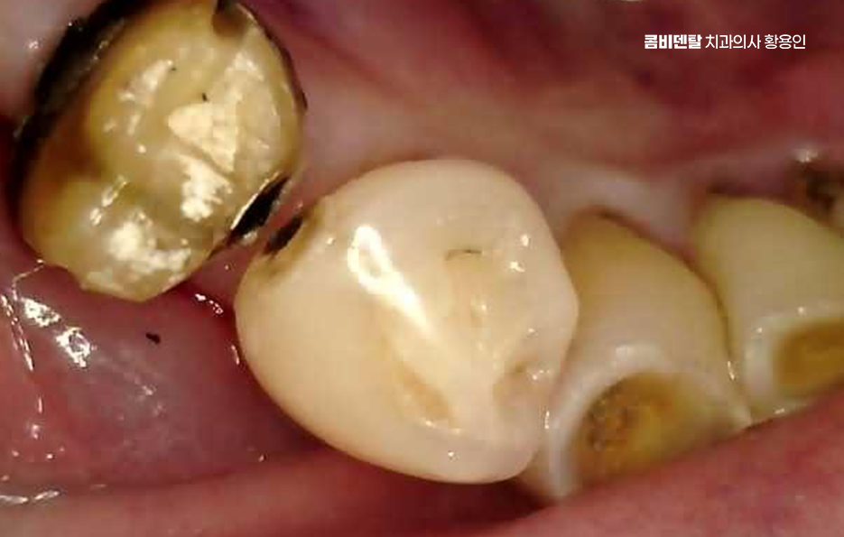 어금니 임플란트 뼈이식 이럴때 해당됩니다 관련 이미지 5