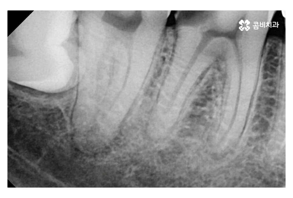 신경치료 후 크라운 시기를 놓치지 않으려면 관련 이미지 4