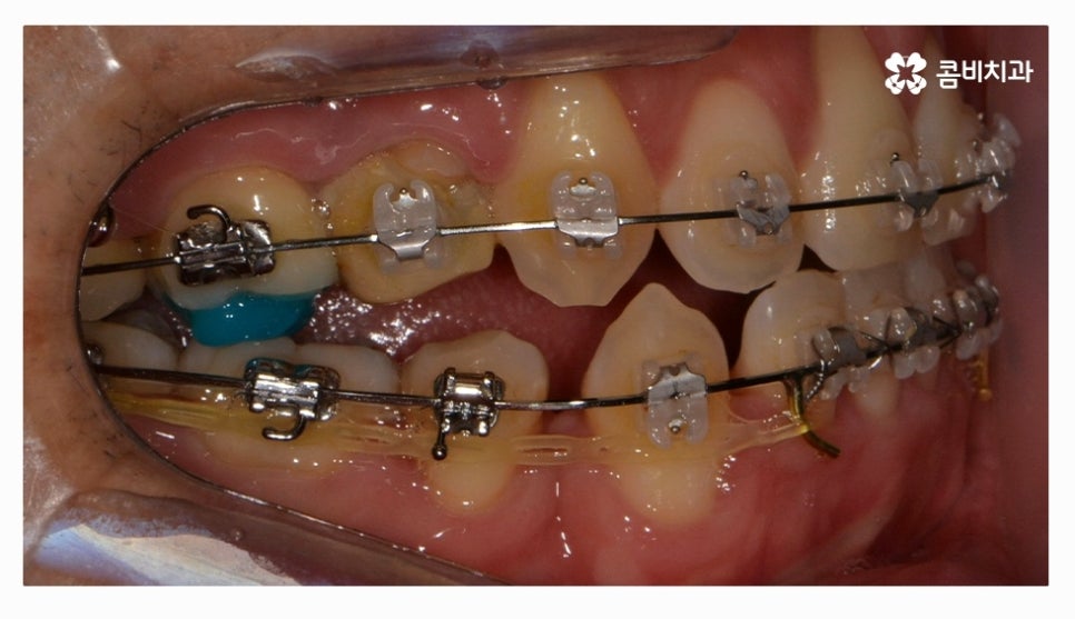 클리피씨교정 올바르게 판단하려면 관련 이미지 11