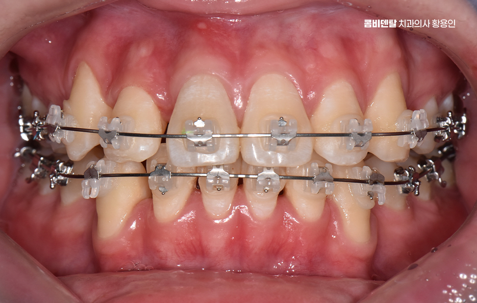 송곳니 덧니 발치 이럴때 해당되네요 관련 이미지 10