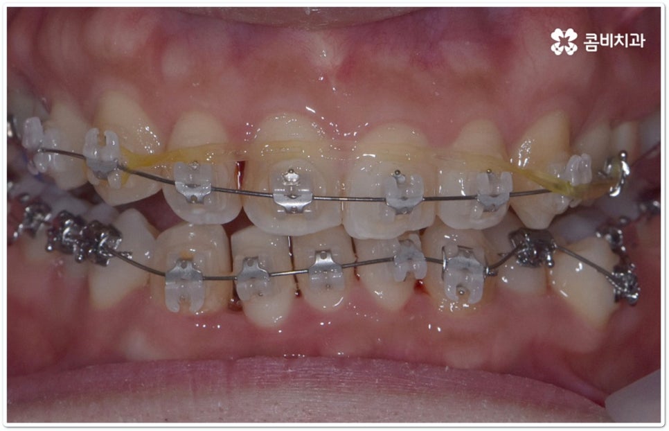 클리피씨교정 합리적인 초이스! 관련 이미지 6