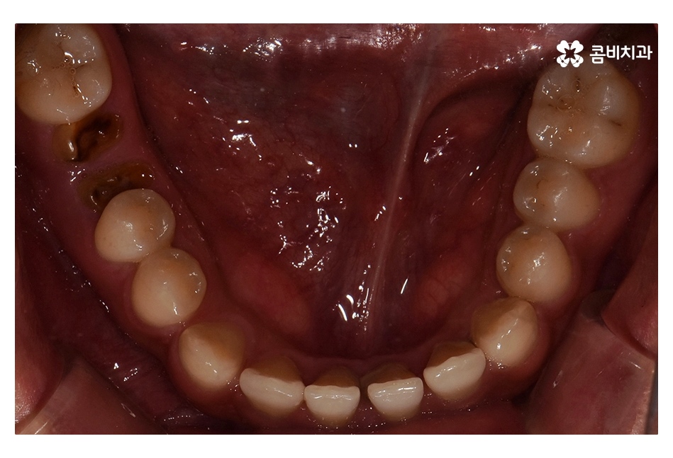 클리피씨교정 늦지않게 결정하려면 관련 이미지 5
