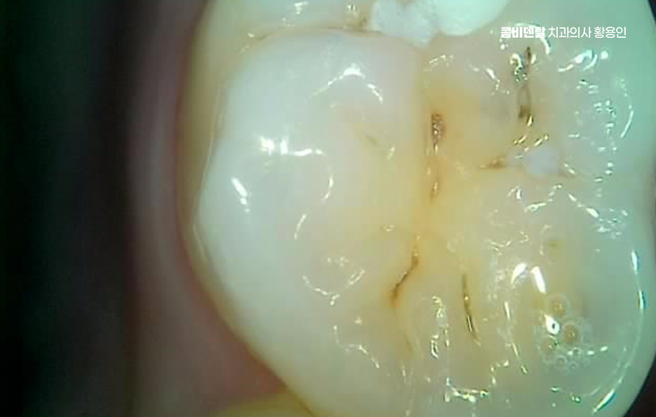 명동치과 흔하게 놓치는 사례를 정리해요 관련 이미지 5
