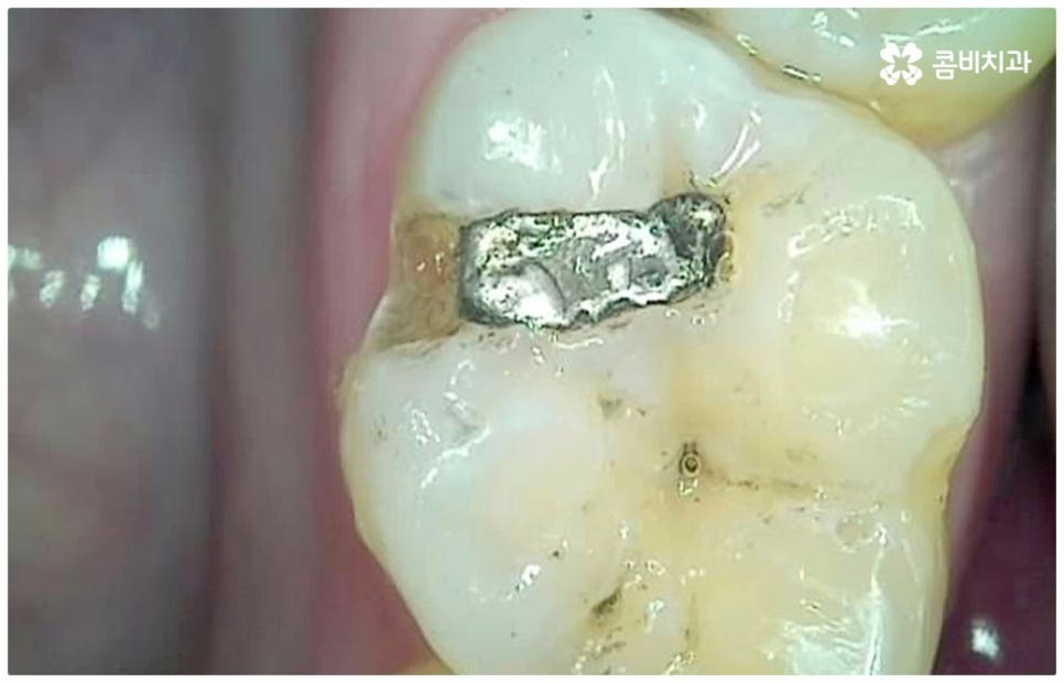 어금니충치치료 아프다면 빨리 관련 이미지 1