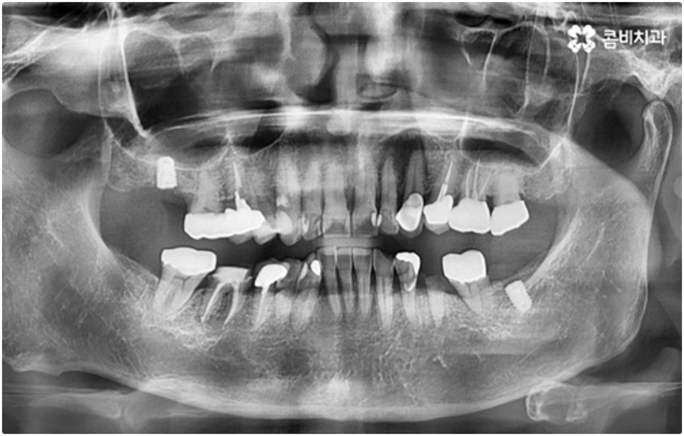어금니임플란트 살펴볼 사항들은 무엇인가요? 관련 이미지 5