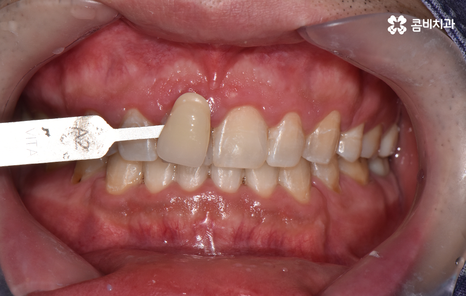 치과 치아미백 이렇게 시작해보세요 관련 이미지 7