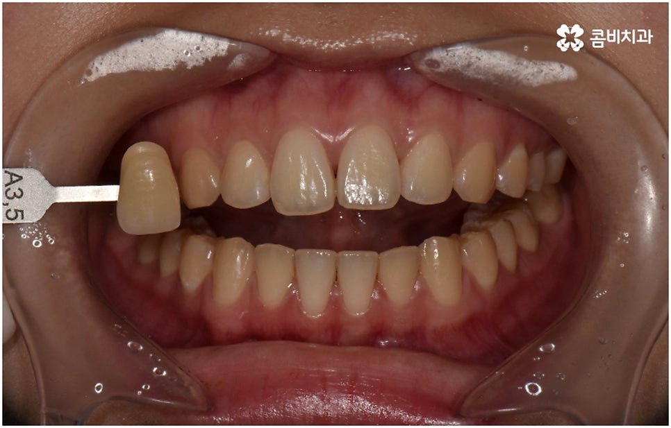 누런치아 하얗게 바꾸고 싶다면 관련 이미지 3