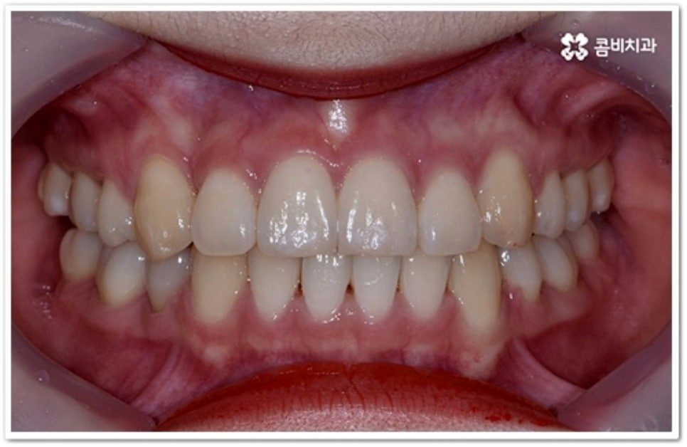 덧니 발치 언제 하나요? 관련 이미지 11