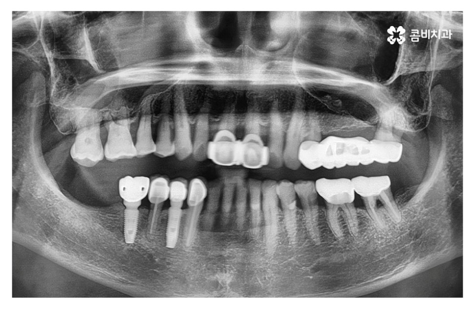 임플란트 기간 케이스에 따라 달라진다면 관련 이미지 1