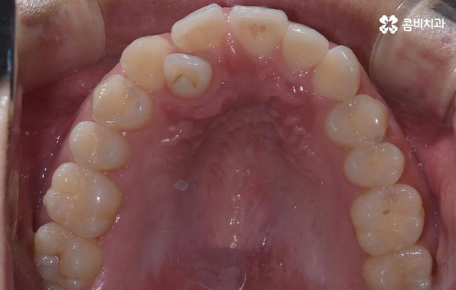 덧니 발치교정으로 교정할 때 치아가 이렇게 이동해요 관련 이미지 5