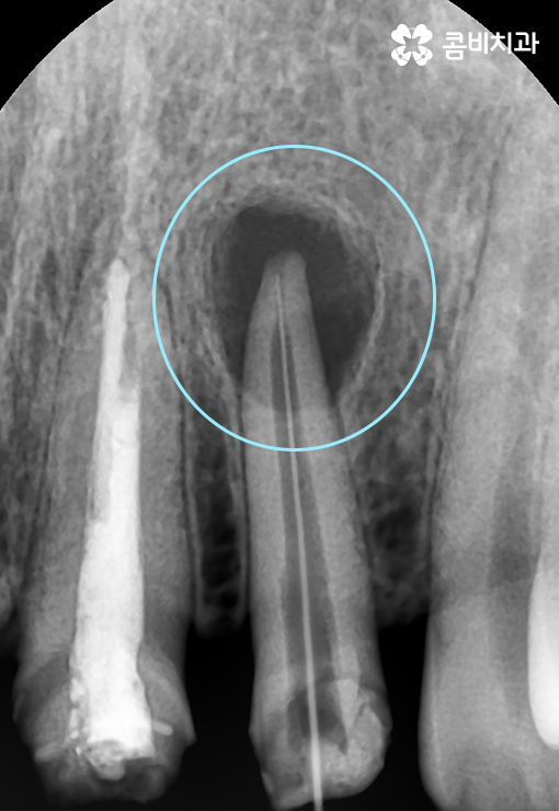 앞니 신경치료 치근단 염증이 발생한 사례 관련 이미지 2