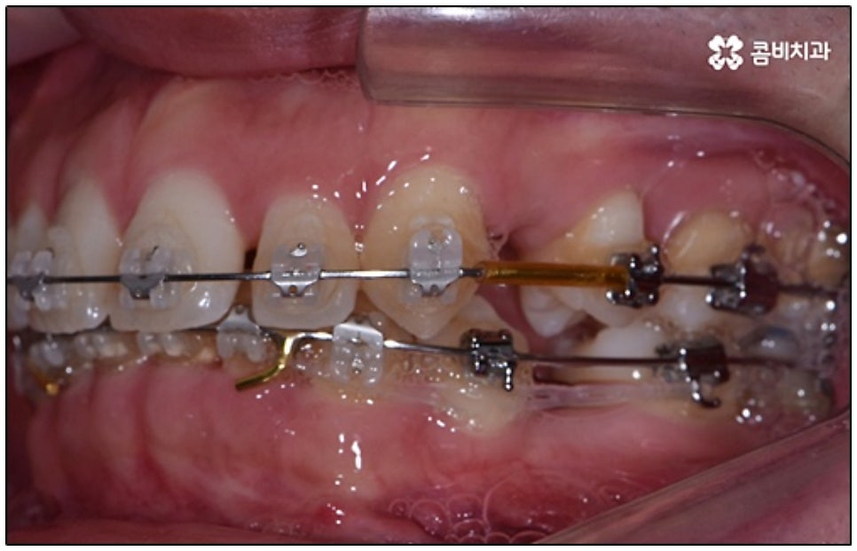클리피씨교정 알아봐야 할것들 관련 이미지 8