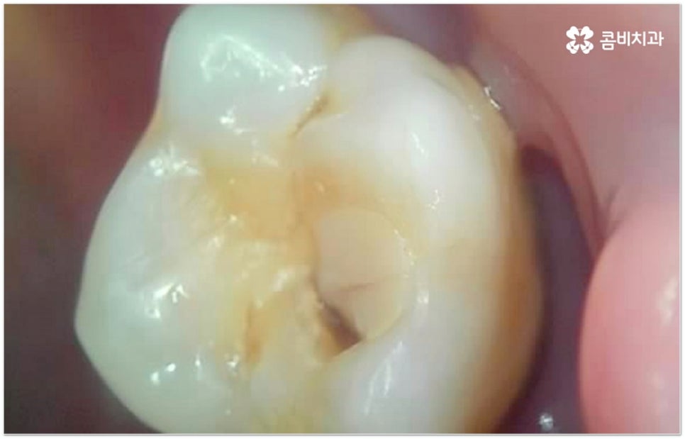 뼈이식임플란트 언제하나요? 관련 이미지 5