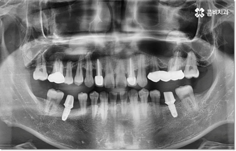 아랫니임플란트 주의할것들은? 관련 이미지 7