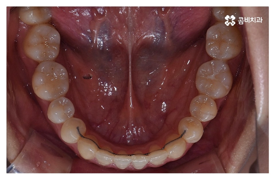 덧니교정 체계적으로 준비하려면 관련 이미지 14