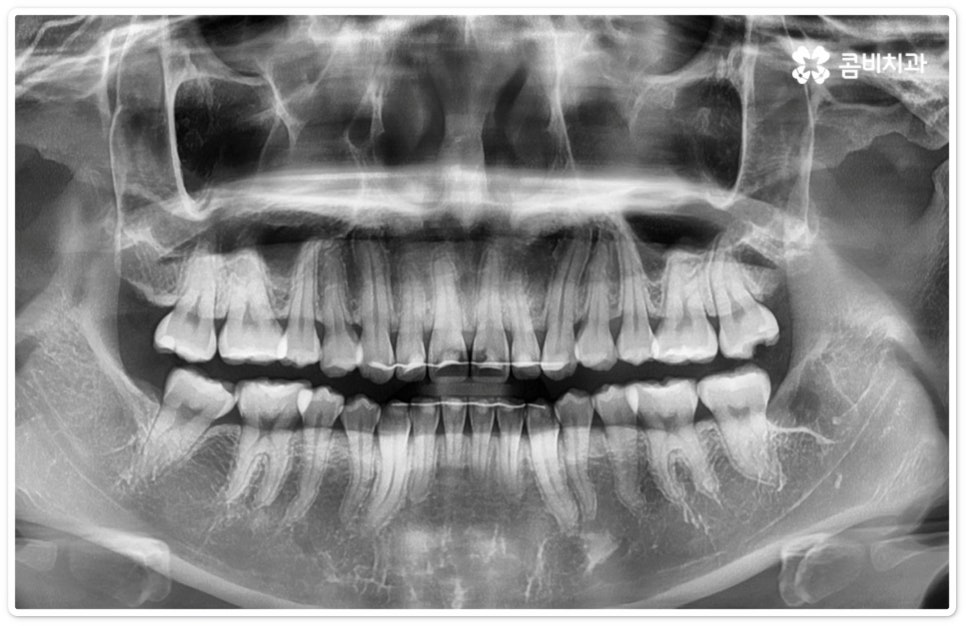 누운사랑니발치 이모저모 알아봐요 관련 이미지 2