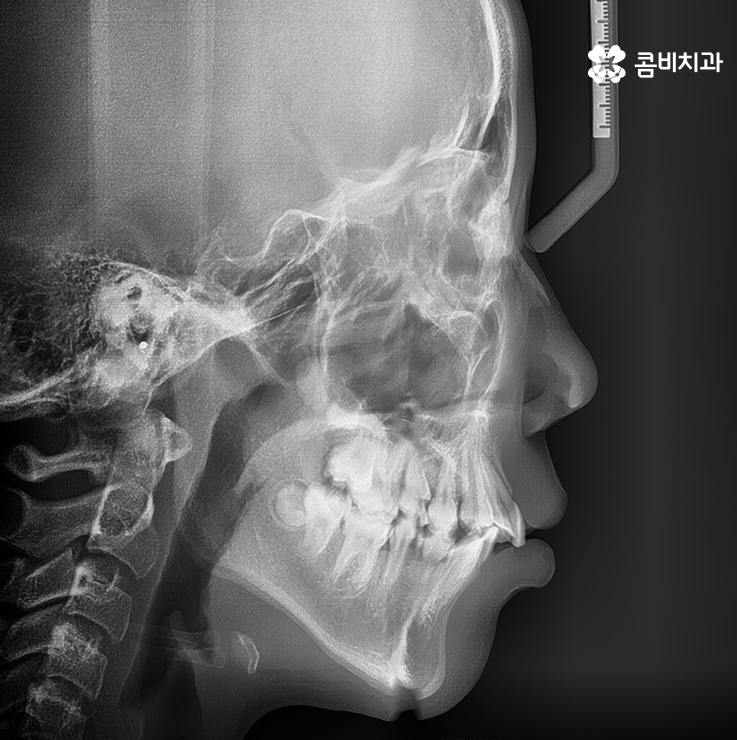 소아치아교정 아직 너무 어린데 괜찮은 걸까? 관련 이미지 6