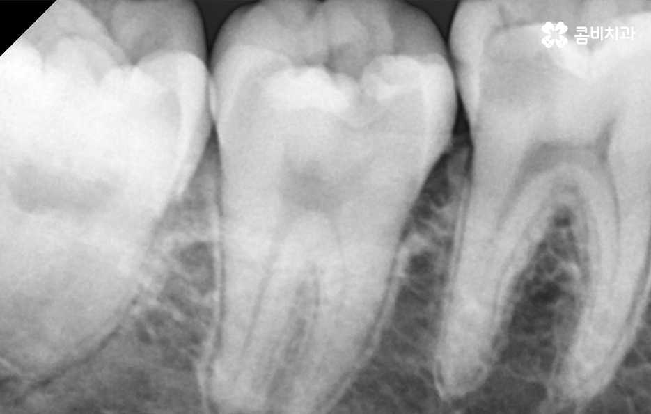 충치 신경치료 안하면 후회하는 이유 관련 이미지 10