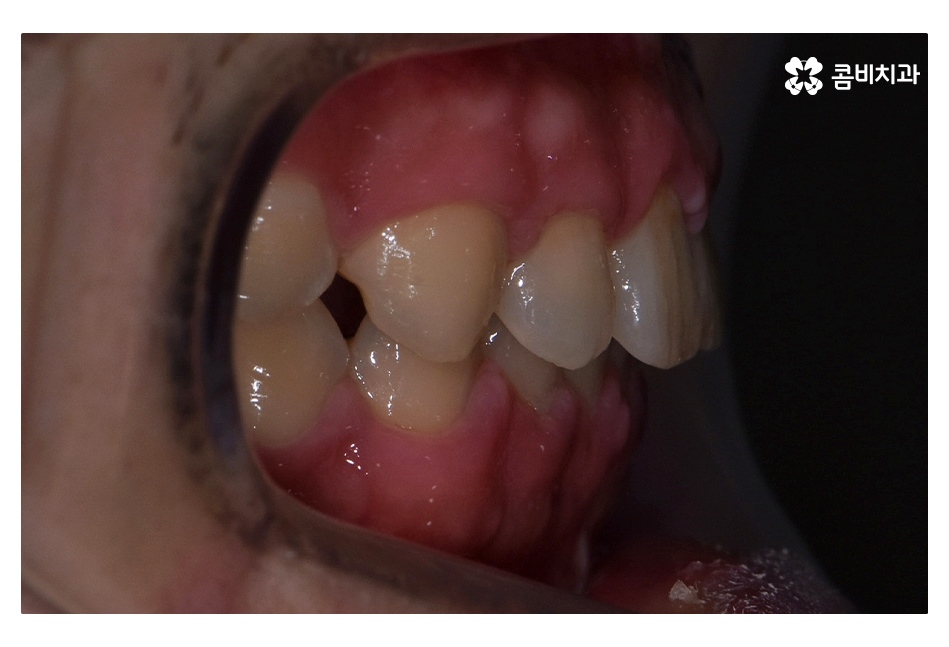 클리피씨교정 늦지않게 결정하려면 관련 이미지 15