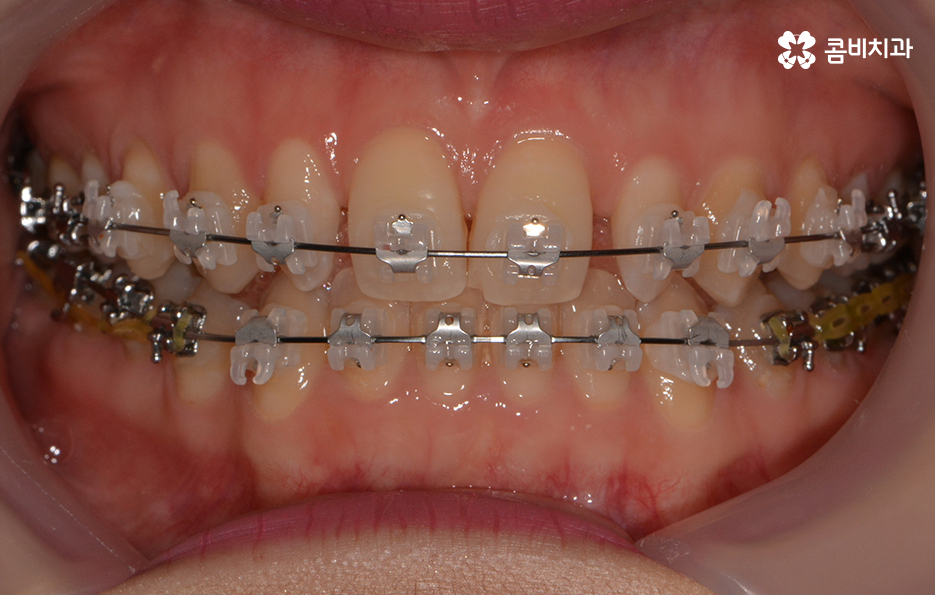 앞니 깨짐 치료와 교정이 병행되었던 사례 관련 이미지 5