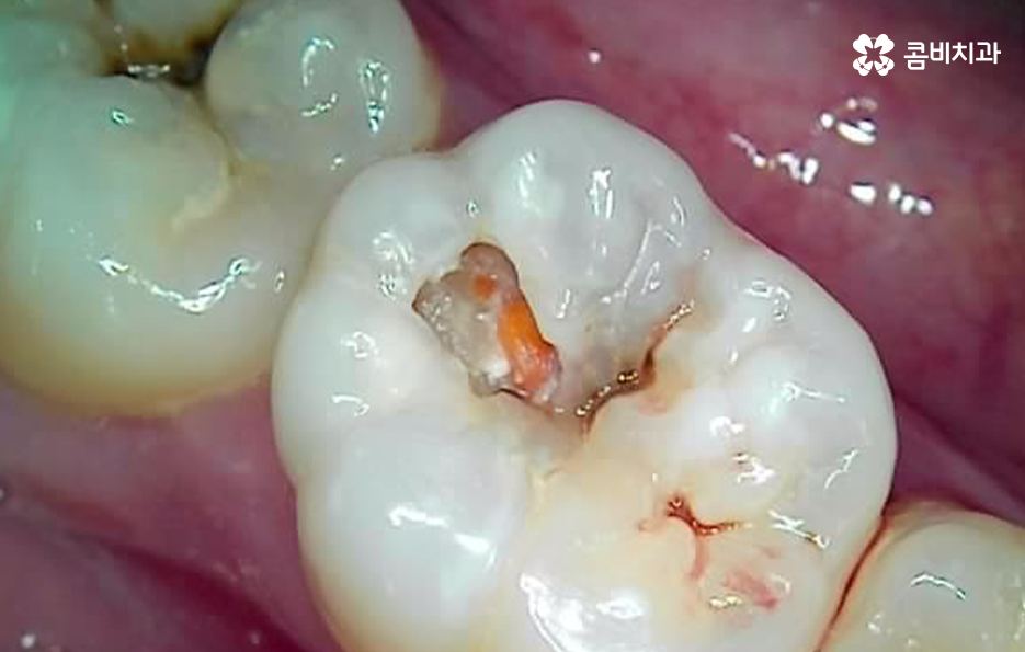 충치 신경치료 안하면 후회하는 이유 관련 이미지 8