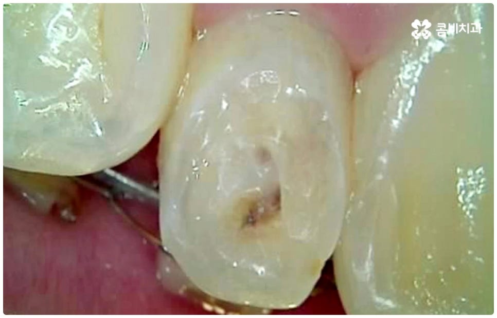 충치치료종류 알아볼까요? 관련 이미지 8