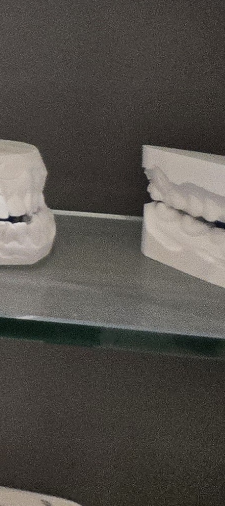 앞이빨 임플란트 과정 주의해야할 포인트는 관련 이미지 35