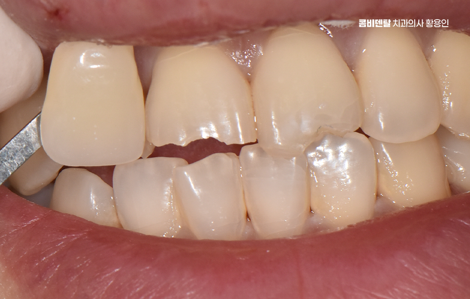How to Use Laminate Veneers for Chipped Front Teeth image 1