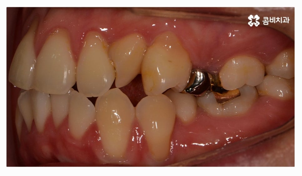클리피씨교정 올바르게 판단하려면 관련 이미지 3