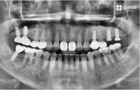 명동치과 타고난 이의 수명은 관련 이미지 9