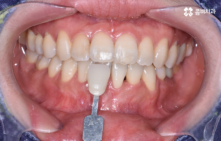 치과 치아미백 이렇게 시작해보세요 관련 이미지 5