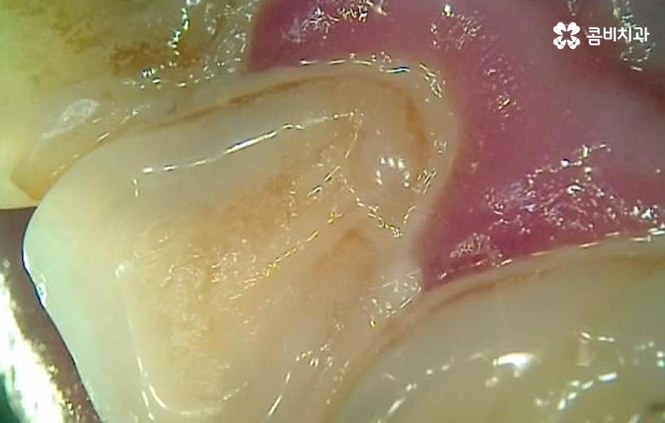 충치 단계 어떻게 분류하고 치료해야 하나요 관련 이미지 11
