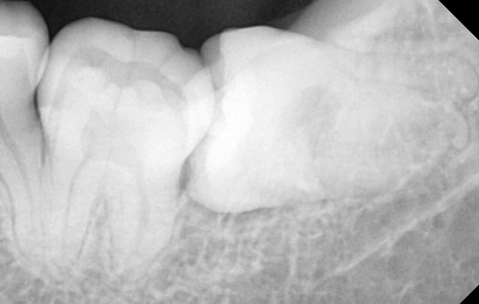 사랑니발치통증 이렇게 해야 쉬워져요 관련 이미지 5