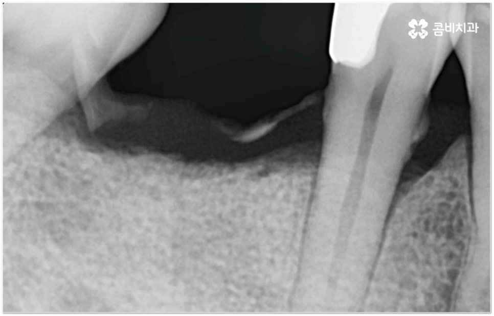 뼈이식임플란트 언제하나요? 관련 이미지 9