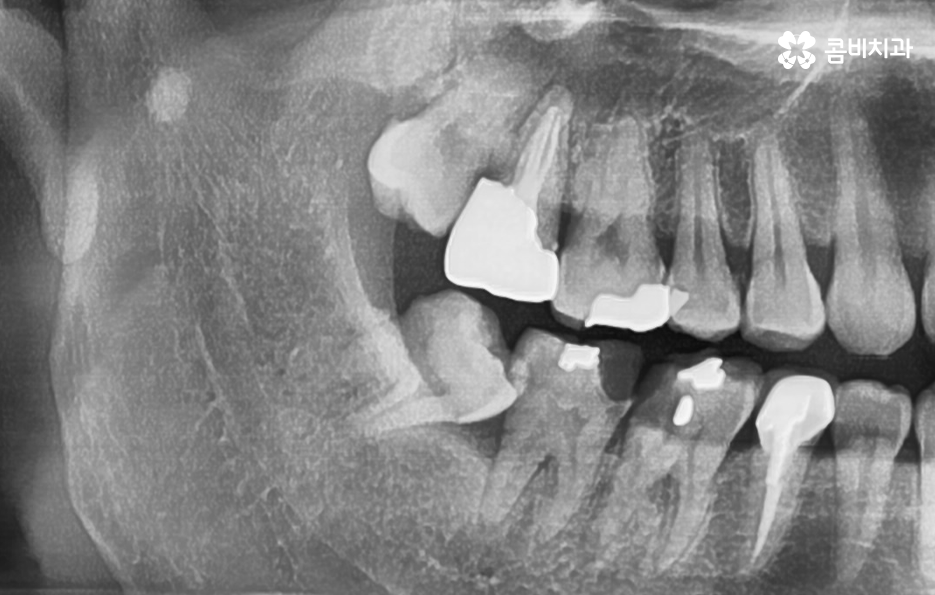 누워있는 사랑니 꼭 뽑아야 하는 경우는 언제일까 관련 이미지 6
