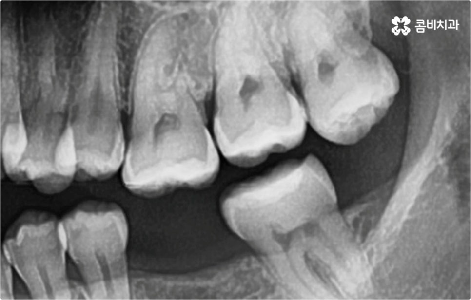 치아설측교정 보이지않아 좋아요 관련 이미지 2