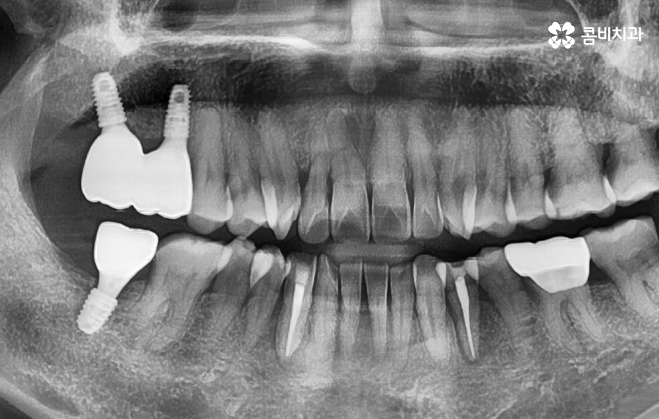 어금니 임플란트 기간 얼마나 예상해야 하나요 관련 이미지 8