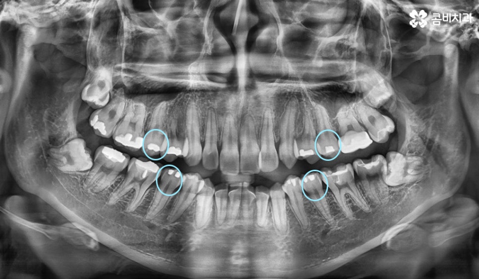 콤비교정 나에게 적합한지 판단하려면 관련 이미지 6