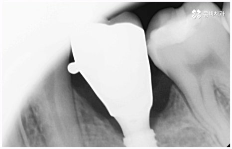 임플란트 종류 어떤게 맞을까요? 관련 이미지 7