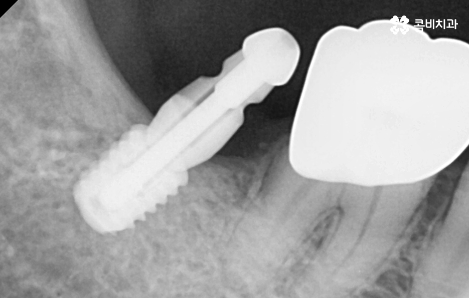 임플란트 치료기간 어느정도 걸리고 치과에는 몇번 가나요 관련 이미지 8
