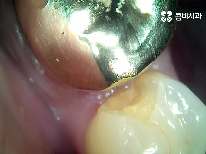 치아 깨짐 다시 튼튼하게 수복하기 위한 방법 관련 이미지 4