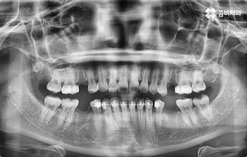 직장인치아교정 어떻게 시작하나요? 관련 이미지 10