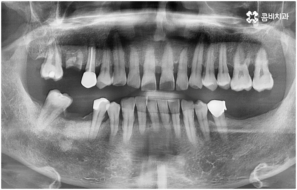 발치후 임플란트 바로 되나요? 관련 이미지 1