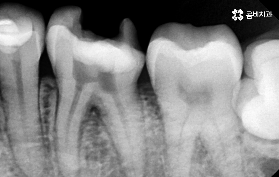 사랑니 어금니 통증 동시에 아프다면 관련 이미지 5