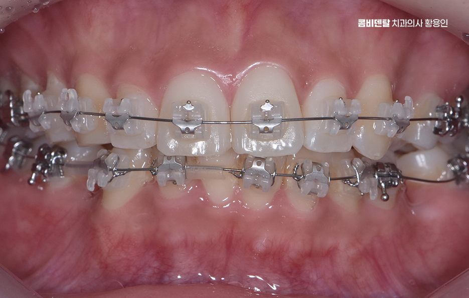 앞니 틀어짐 교정 이렇게 파악하세요 관련 이미지 8