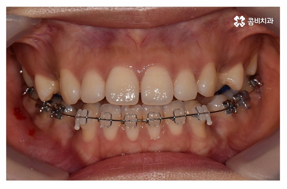 돌출입치아교정 적극적으로 해결하려면 관련 이미지 11