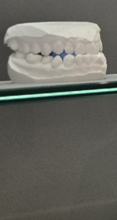 완전매복사랑니 발치 대학병원 꼭 가야하나요 관련 이미지 31