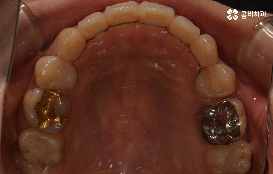 콤비교정 나에게 적합한지 판단하려면 관련 이미지 16